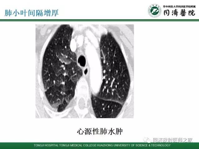 【PPT】间质性肺疾病的影响学表现