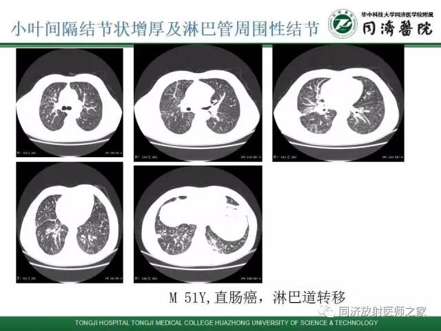 【PPT】间质性肺疾病的影响学表现