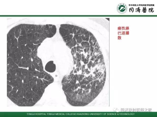 【PPT】间质性肺疾病的影响学表现