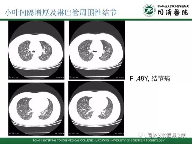 【PPT】间质性肺疾病的影响学表现