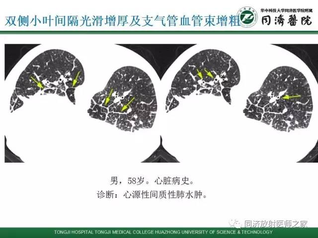 【PPT】间质性肺疾病的影响学表现