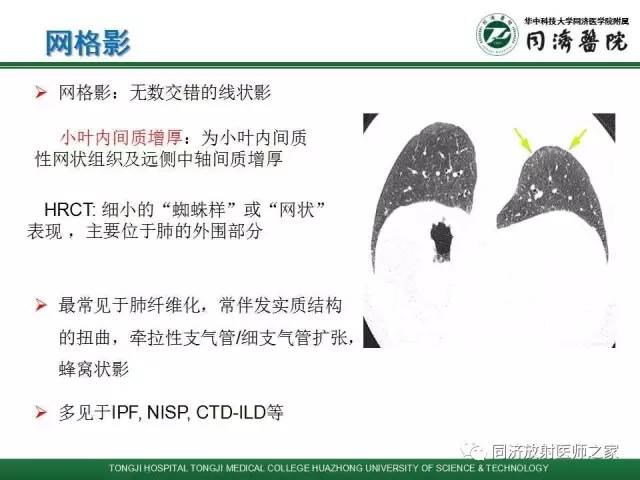 【PPT】间质性肺疾病的影响学表现