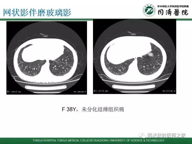 【PPT】间质性肺疾病的影响学表现