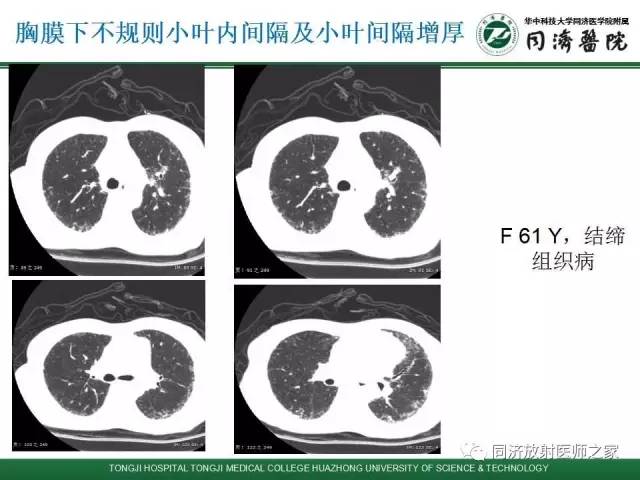 【PPT】间质性肺疾病的影响学表现