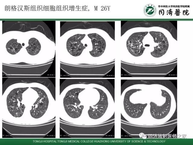 【PPT】间质性肺疾病的影响学表现