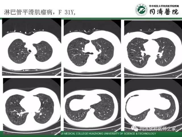 【PPT】间质性肺疾病的影响学表现