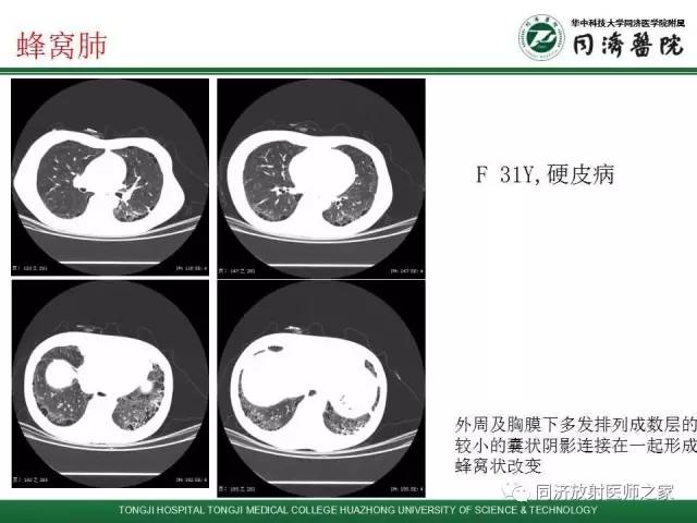 【PPT】间质性肺疾病的影响学表现