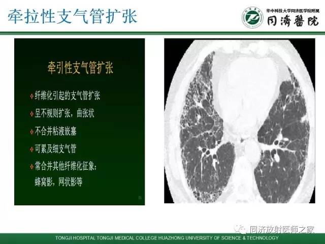【PPT】间质性肺疾病的影响学表现
