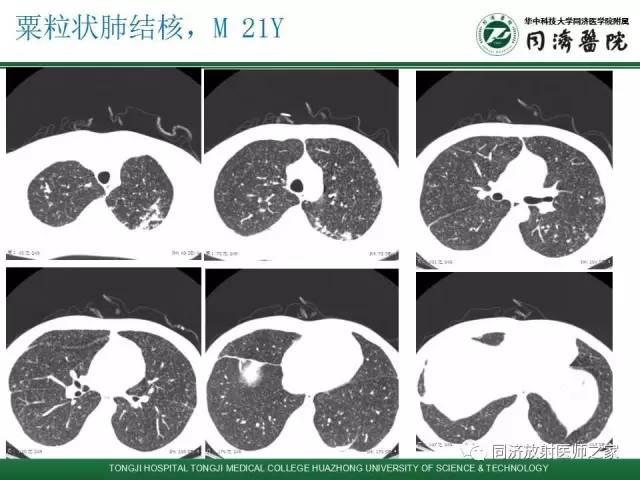 【PPT】间质性肺疾病的影响学表现