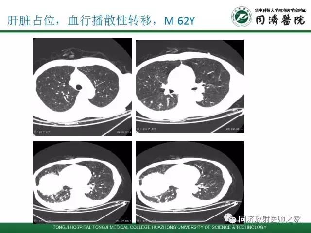 【PPT】间质性肺疾病的影响学表现