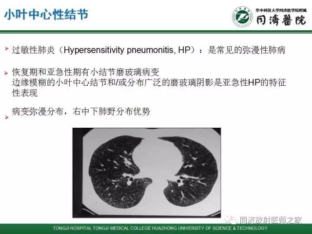【PPT】间质性肺疾病的影响学表现