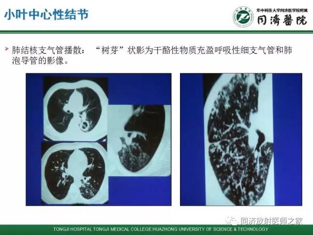 【PPT】间质性肺疾病的影响学表现