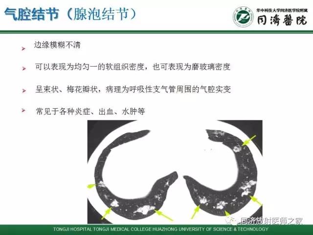 【PPT】间质性肺疾病的影响学表现