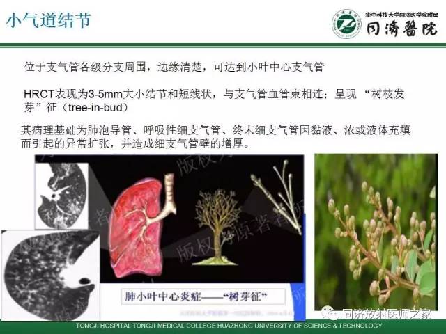 【PPT】间质性肺疾病的影响学表现