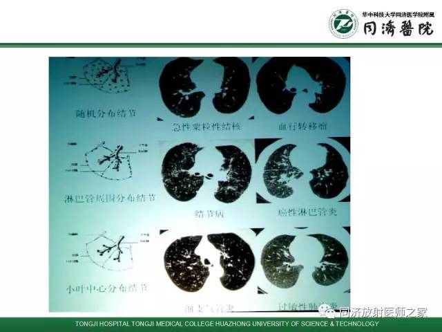 【PPT】间质性肺疾病的影响学表现