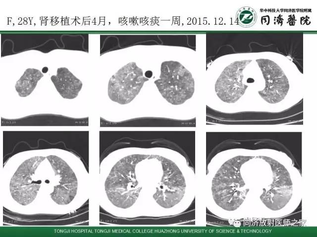 【PPT】间质性肺疾病的影响学表现