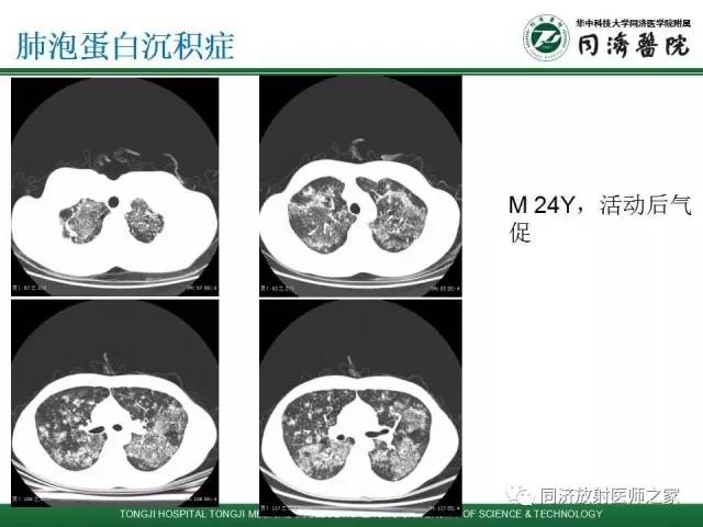 【PPT】间质性肺疾病的影响学表现