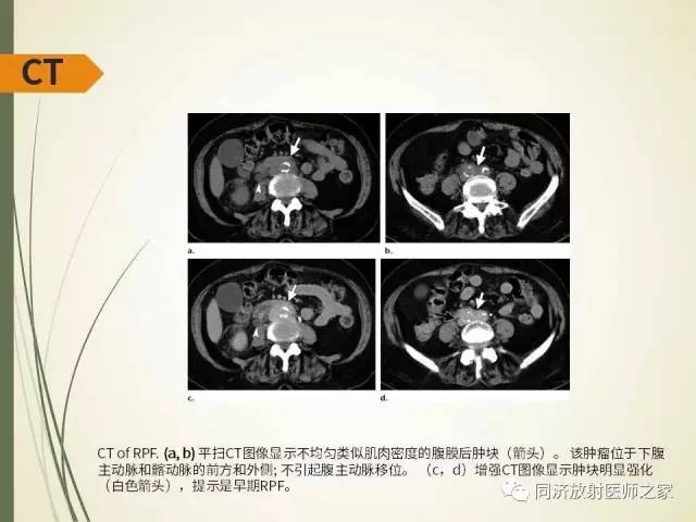 【PPT】腹膜后纤维化