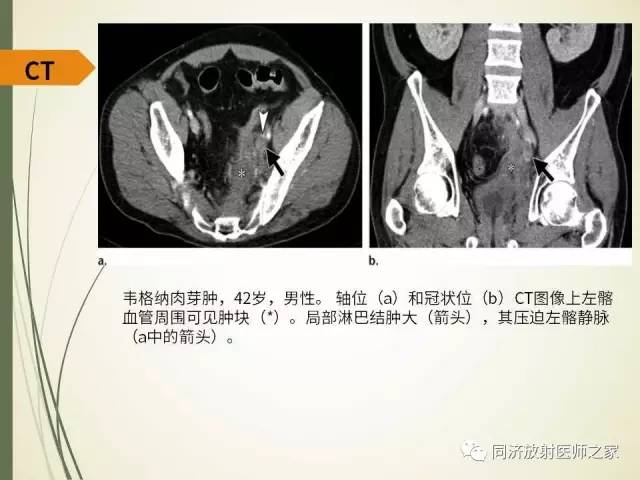 【PPT】腹膜后纤维化