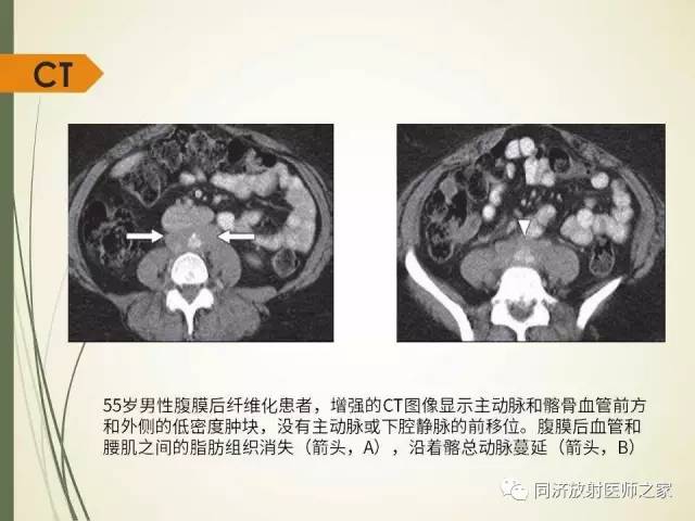 【PPT】腹膜后纤维化