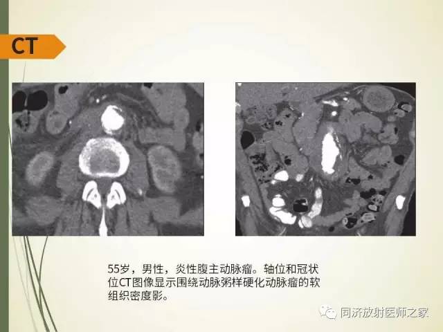 【PPT】腹膜后纤维化