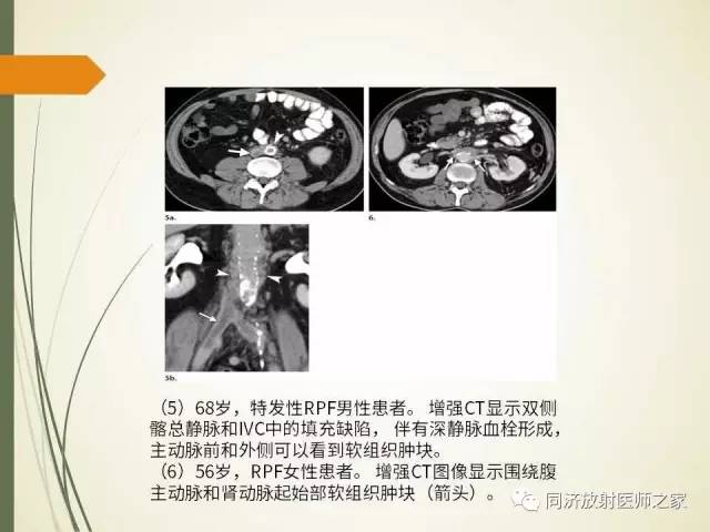 【PPT】腹膜后纤维化