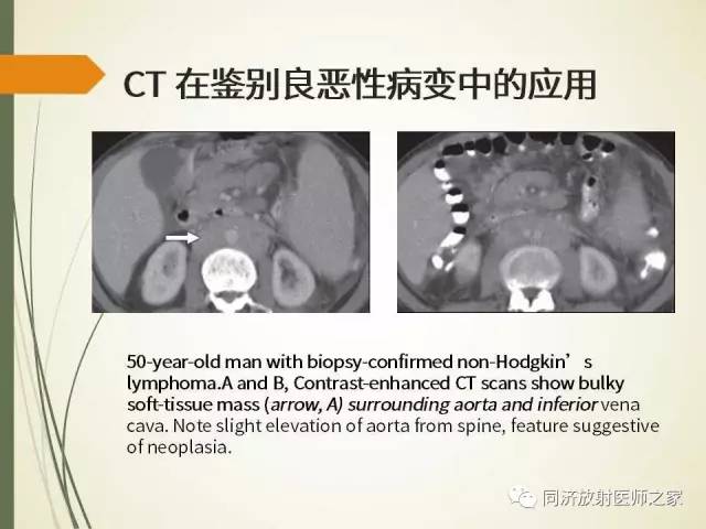 【PPT】腹膜后纤维化