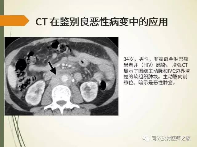 【PPT】腹膜后纤维化