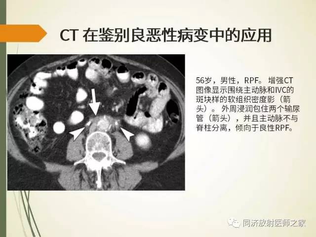 【PPT】腹膜后纤维化