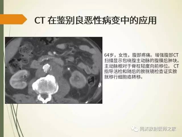 【PPT】腹膜后纤维化