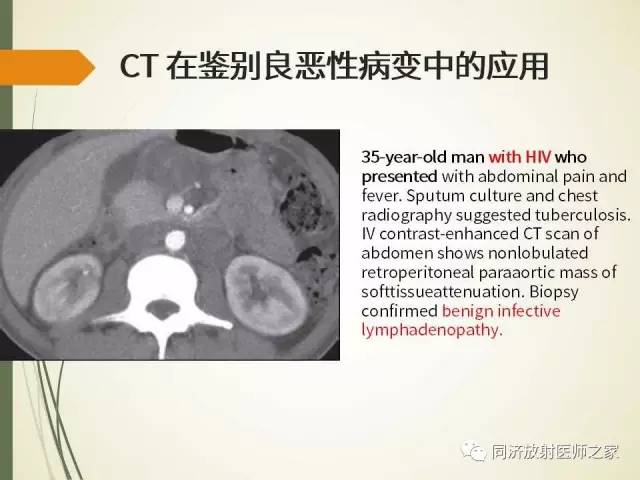 【PPT】腹膜后纤维化