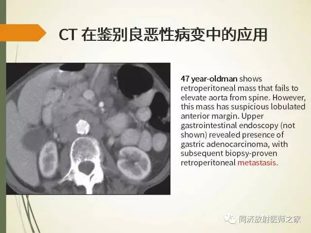 【PPT】腹膜后纤维化