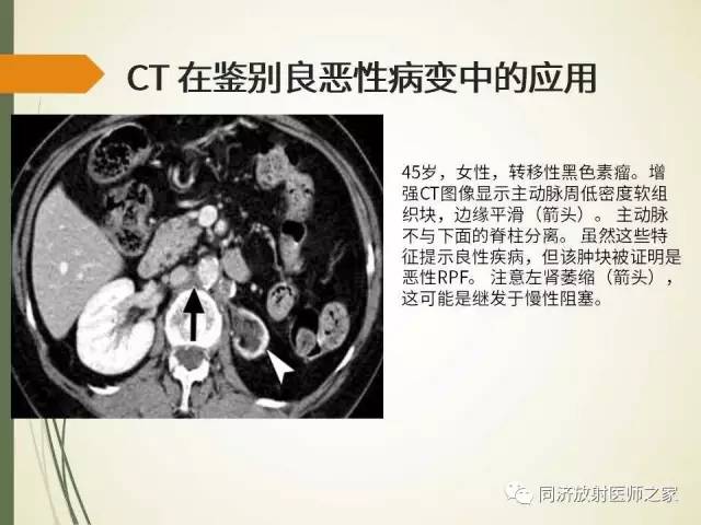 【PPT】腹膜后纤维化