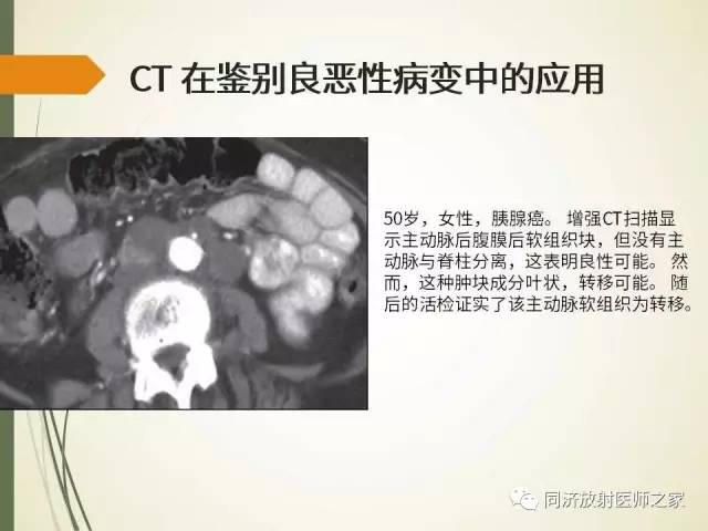 【PPT】腹膜后纤维化