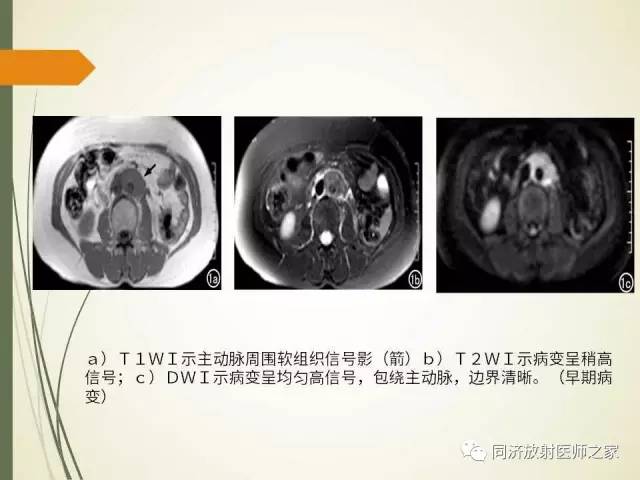 【PPT】腹膜后纤维化