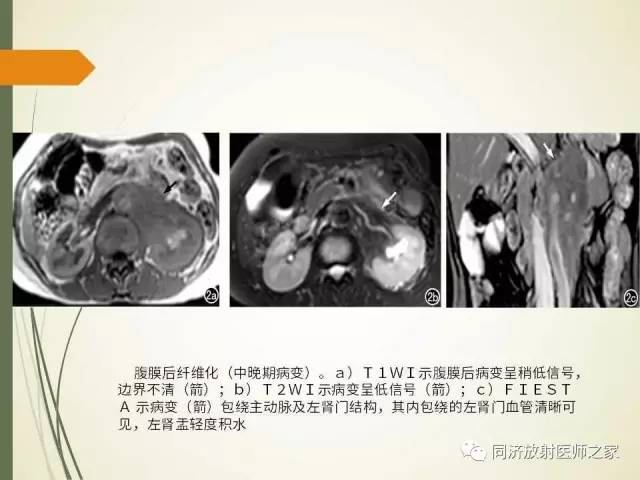 【PPT】腹膜后纤维化
