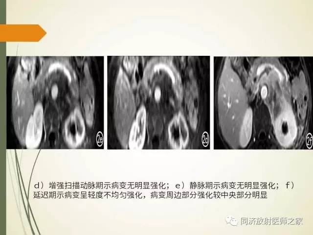【PPT】腹膜后纤维化