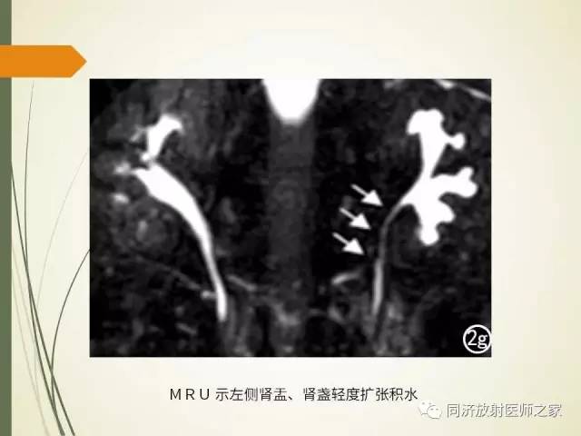 【PPT】腹膜后纤维化