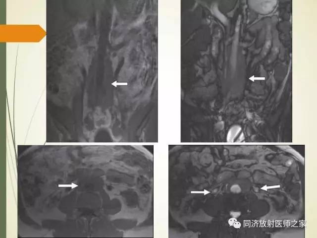 【PPT】腹膜后纤维化