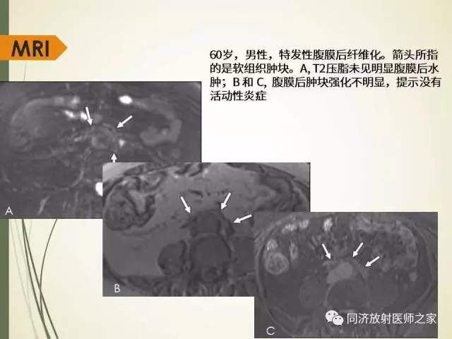 【PPT】腹膜后纤维化