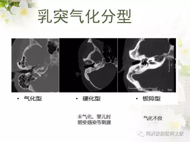 【PPT】耳部CT影像解剖及常见病的认识