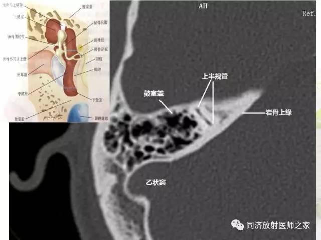 【PPT】耳部CT影像解剖及常见病的认识