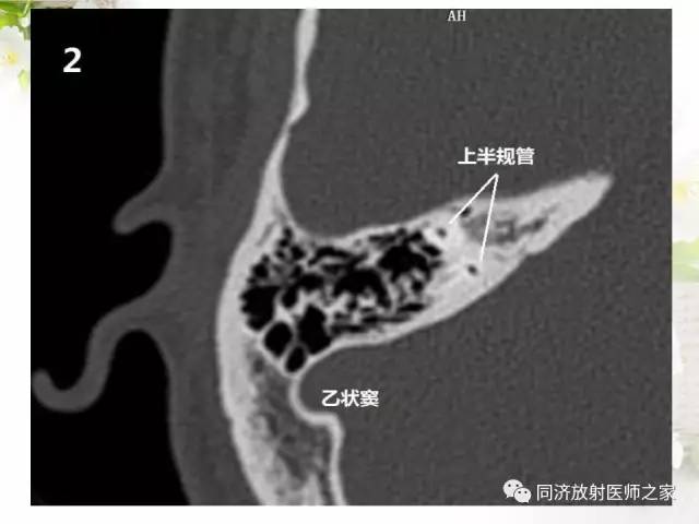 【PPT】耳部CT影像解剖及常见病的认识