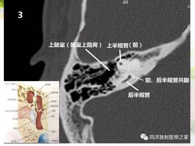 【PPT】耳部CT影像解剖及常见病的认识