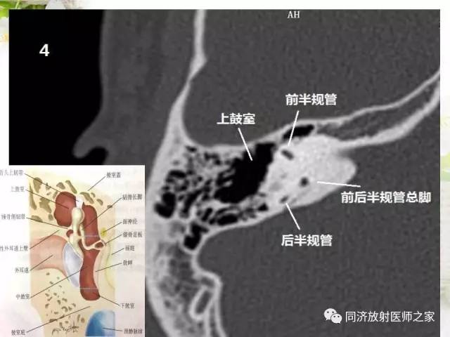 【PPT】耳部CT影像解剖及常见病的认识