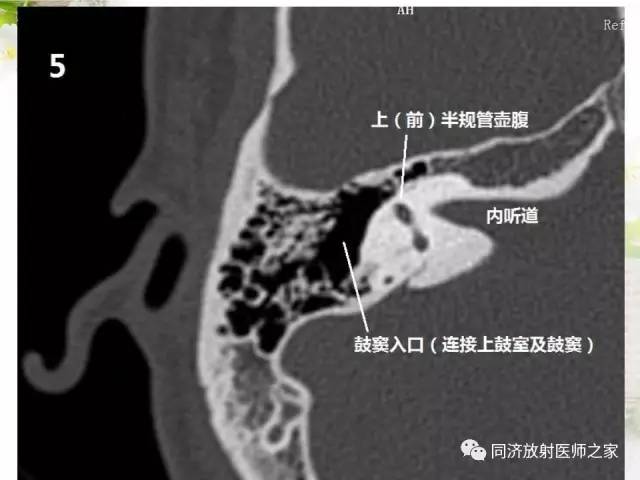 【PPT】耳部CT影像解剖及常见病的认识