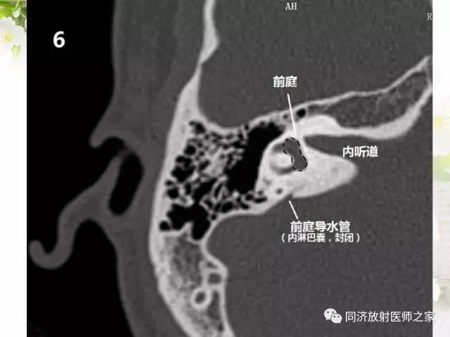 【PPT】耳部CT影像解剖及常见病的认识