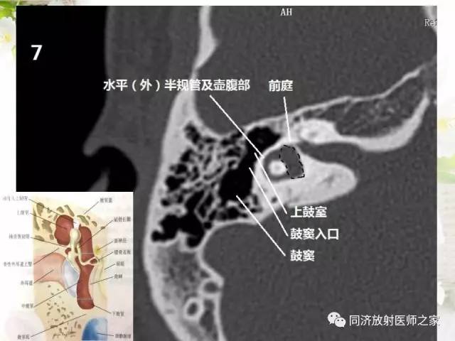 【PPT】耳部CT影像解剖及常见病的认识