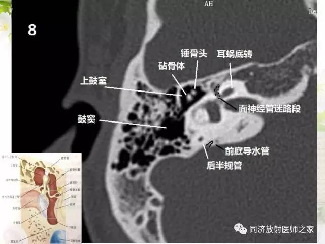 【PPT】耳部CT影像解剖及常见病的认识