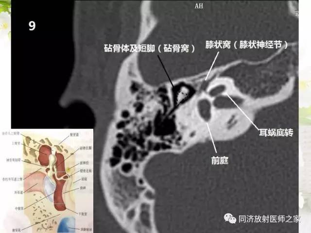 【PPT】耳部CT影像解剖及常见病的认识